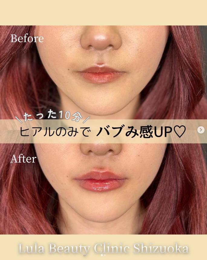 Cカールリップの症例写真