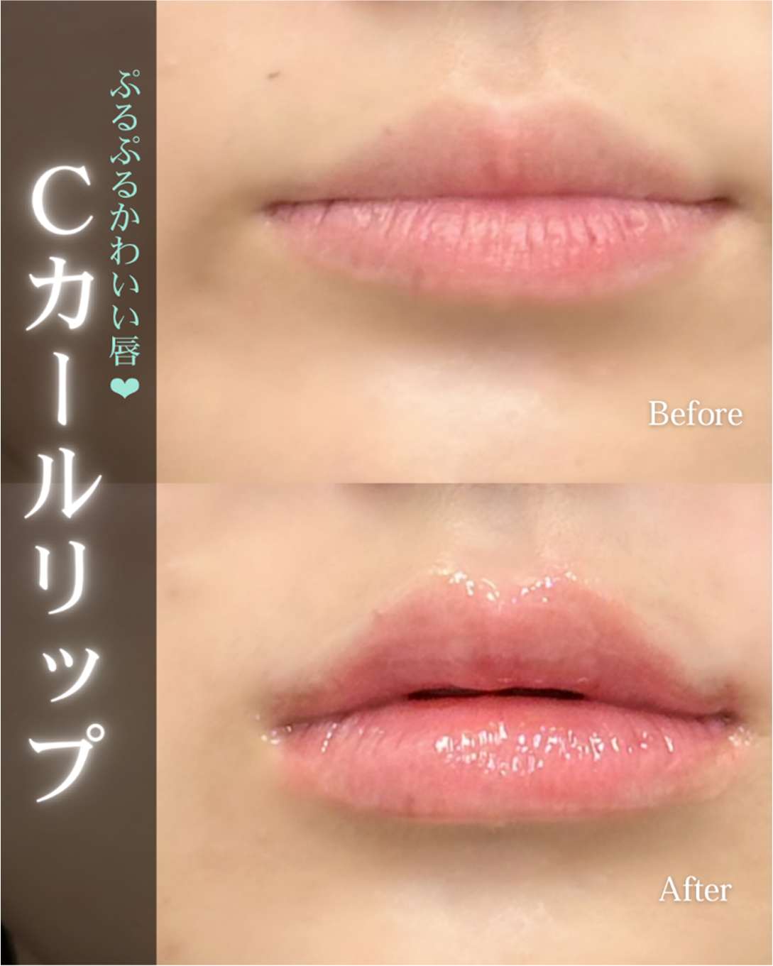 Ｃカールリップの症例写真