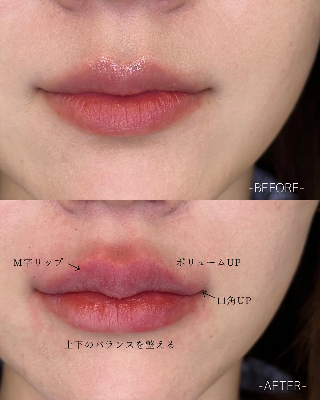 Ｃカールリップの症例写真