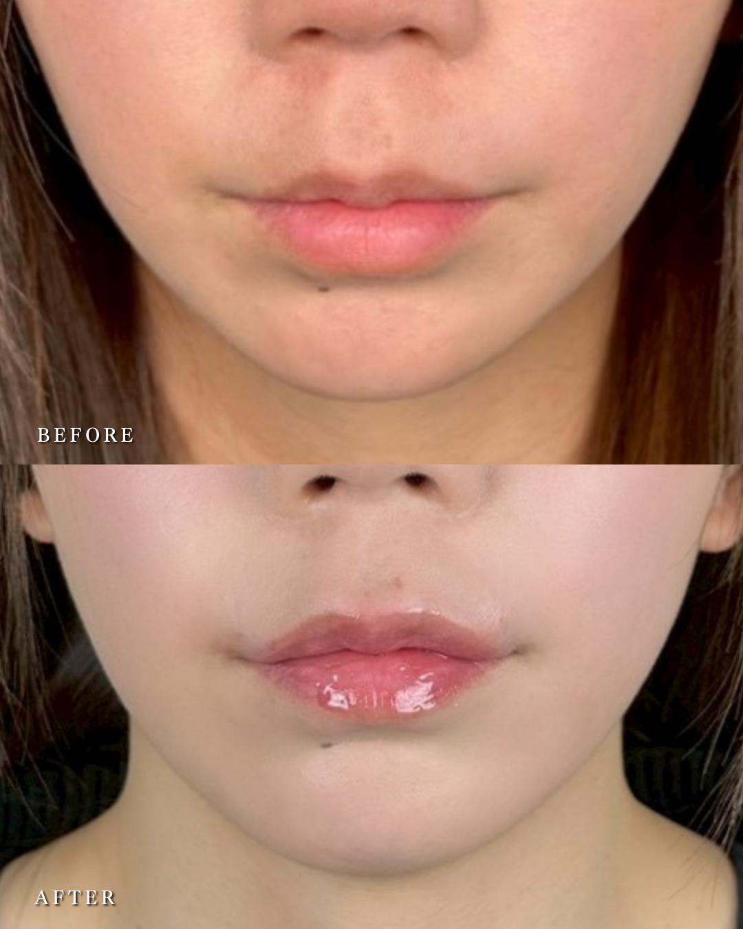 Ｃカールリップの症例写真