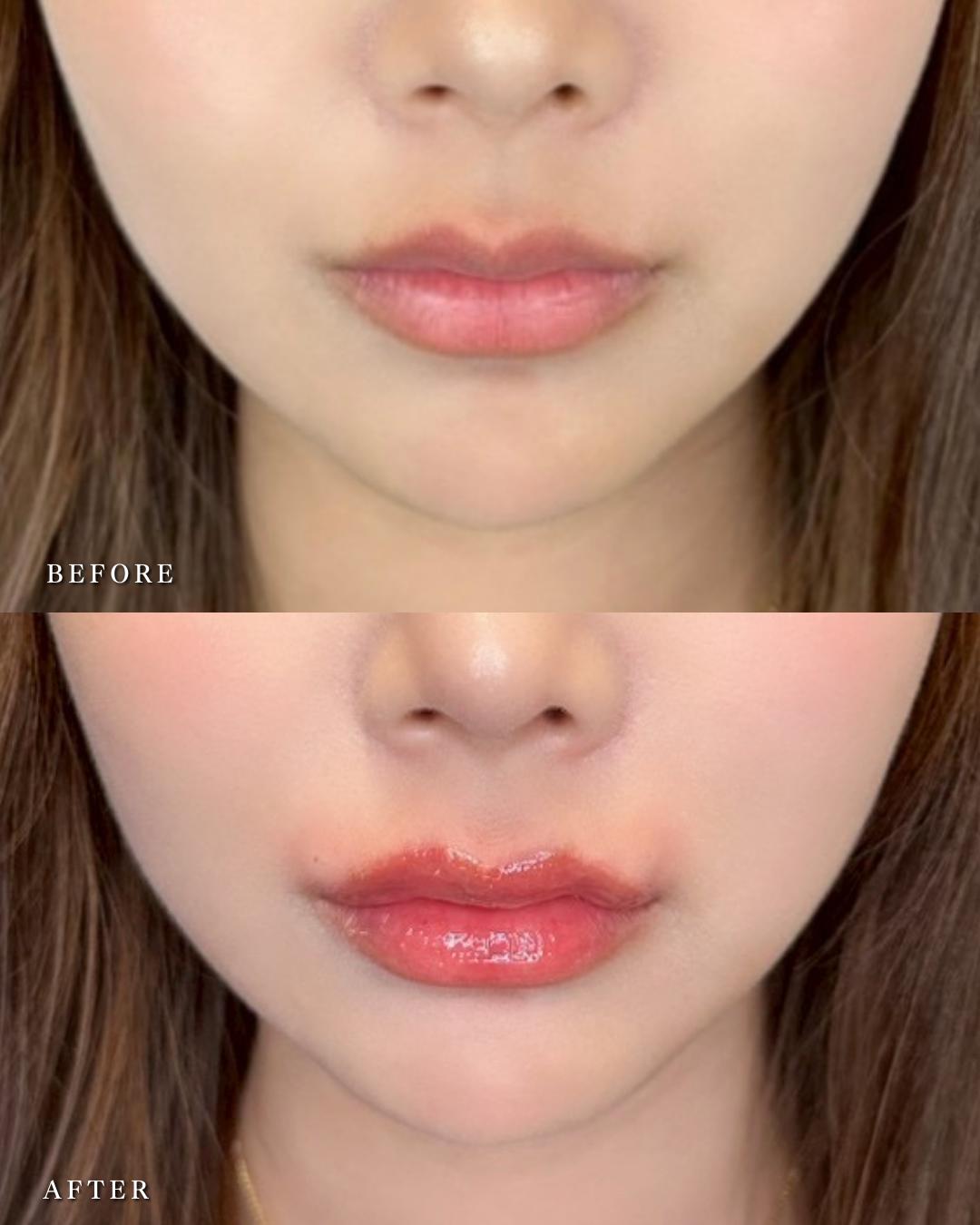 Ｃカールリップの症例写真