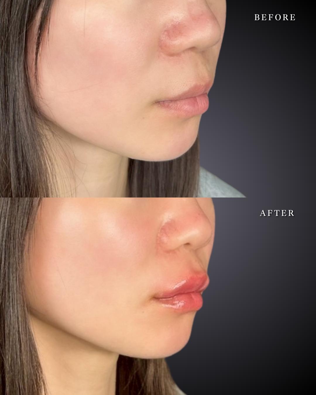 Ｃカールリップの症例写真