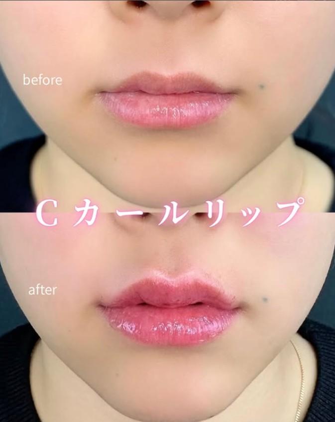 Ｃカールリップの症例写真