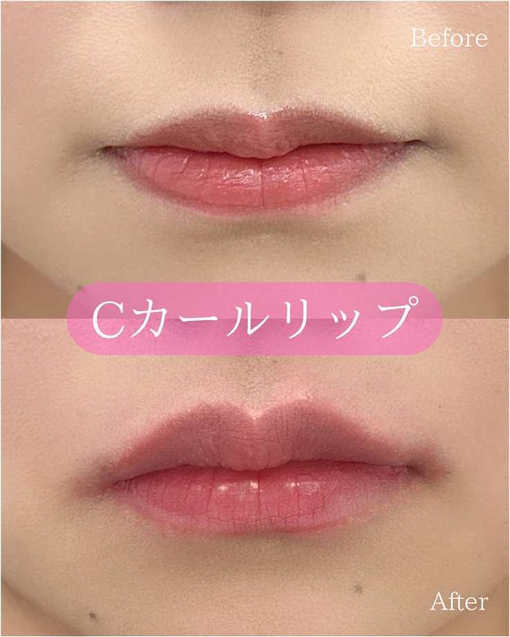 Ｃカールリップの症例写真