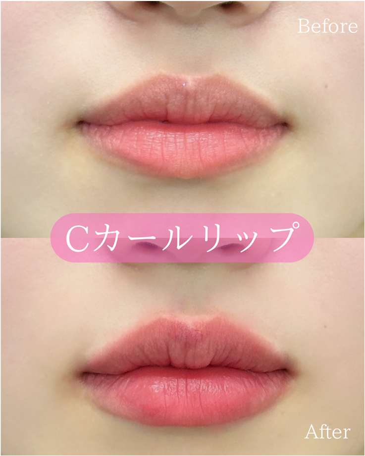Ｃカールリップの症例写真