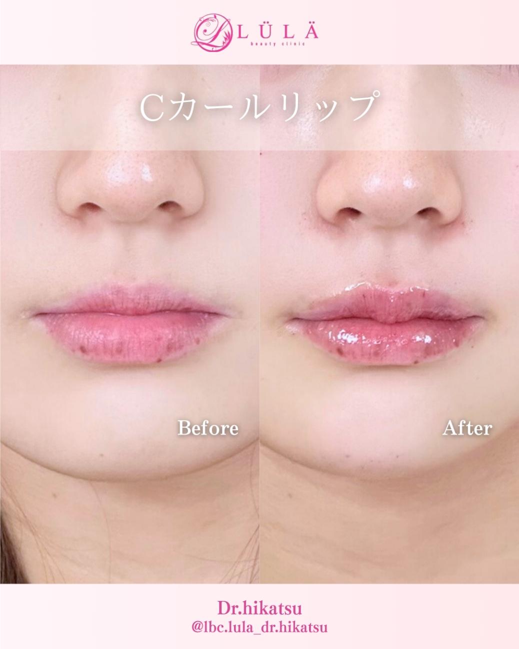 Ｃカールリップの症例写真