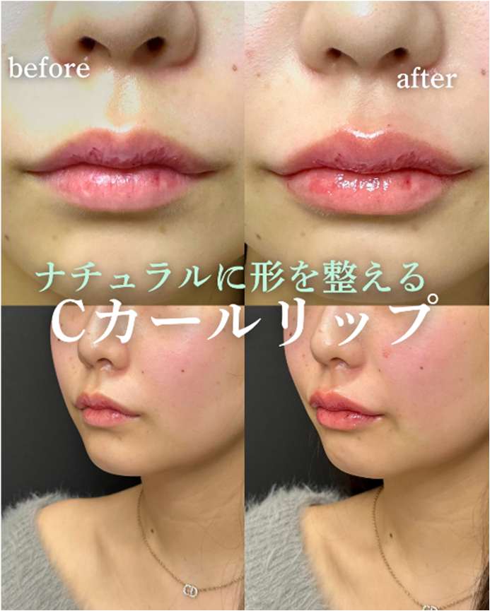 Ｃカールリップの症例写真