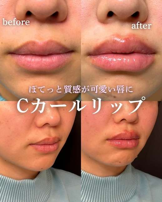 Ｃカールリップの症例写真