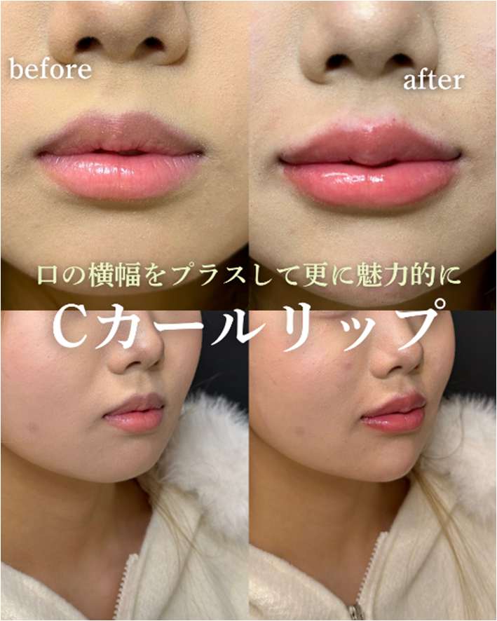 Ｃカールリップの症例写真