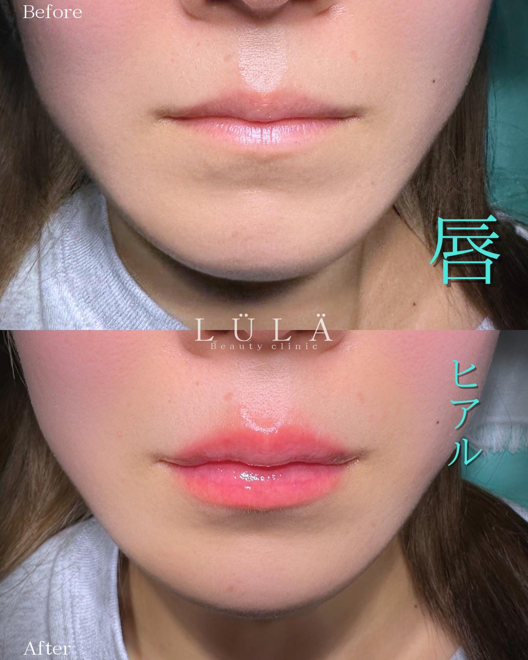 Ｃカールリップの症例写真