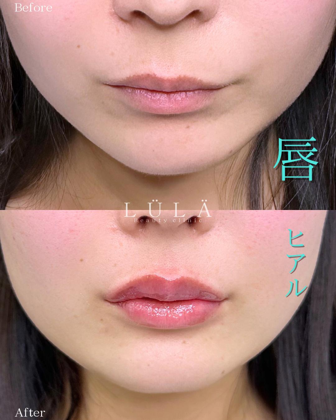 Ｃカールリップの症例写真