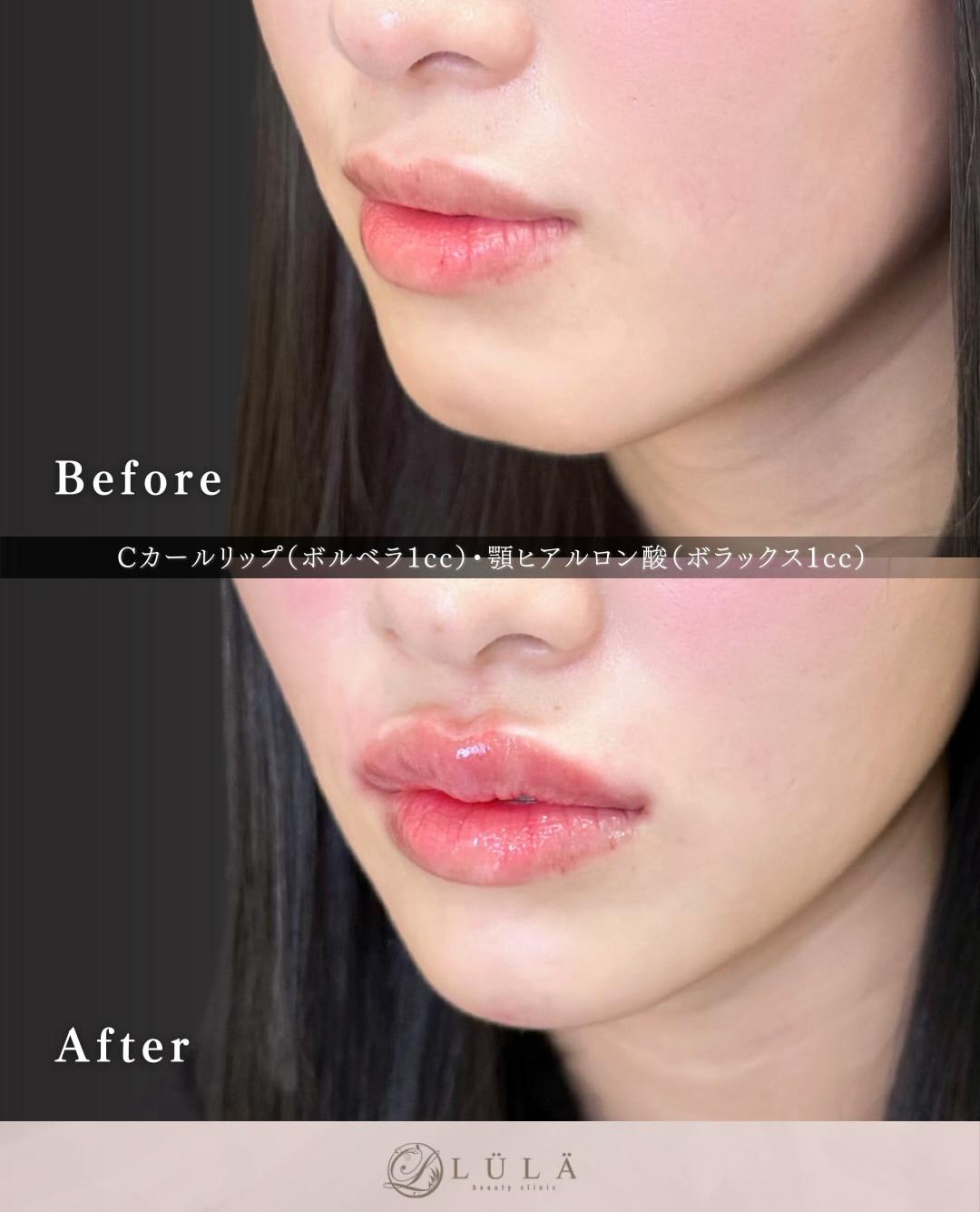 Ｃカールリップの症例写真