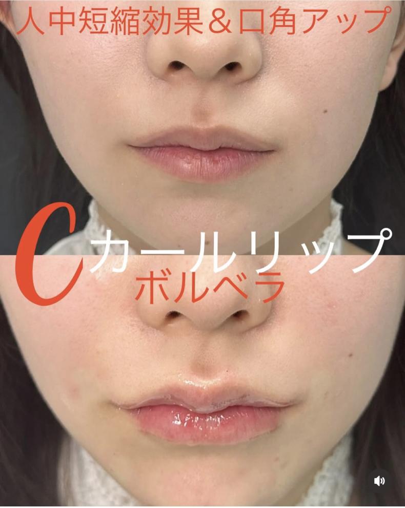 Ｃカールリップの症例写真