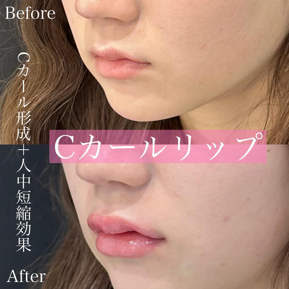 Ｃカールリップの症例写真