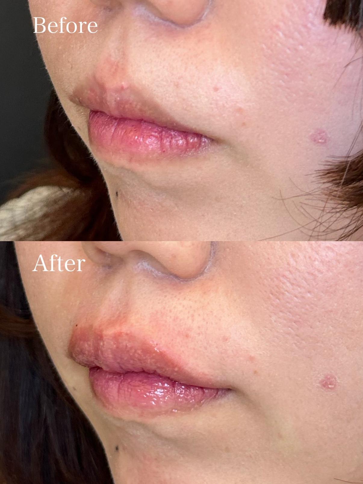 Ｃカールリップの症例写真