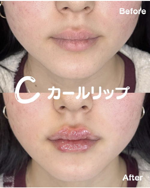 Ｃカールリップの症例写真