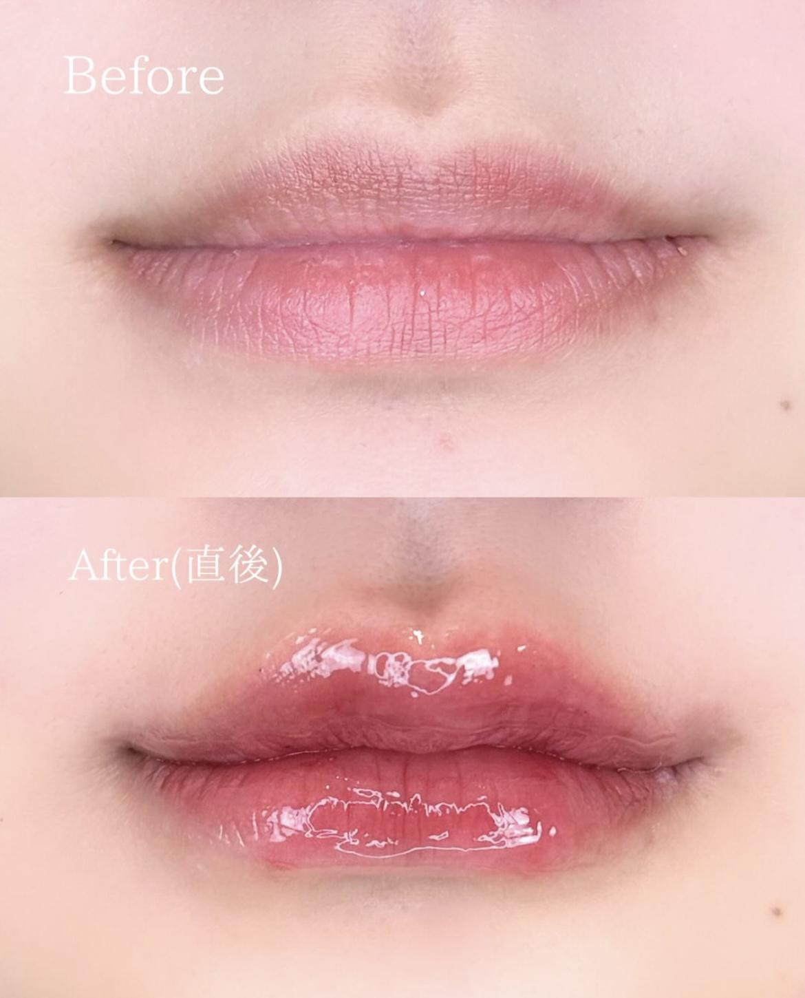 Ｃカールリップの症例写真