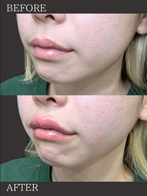 Ｃカールリップの症例写真