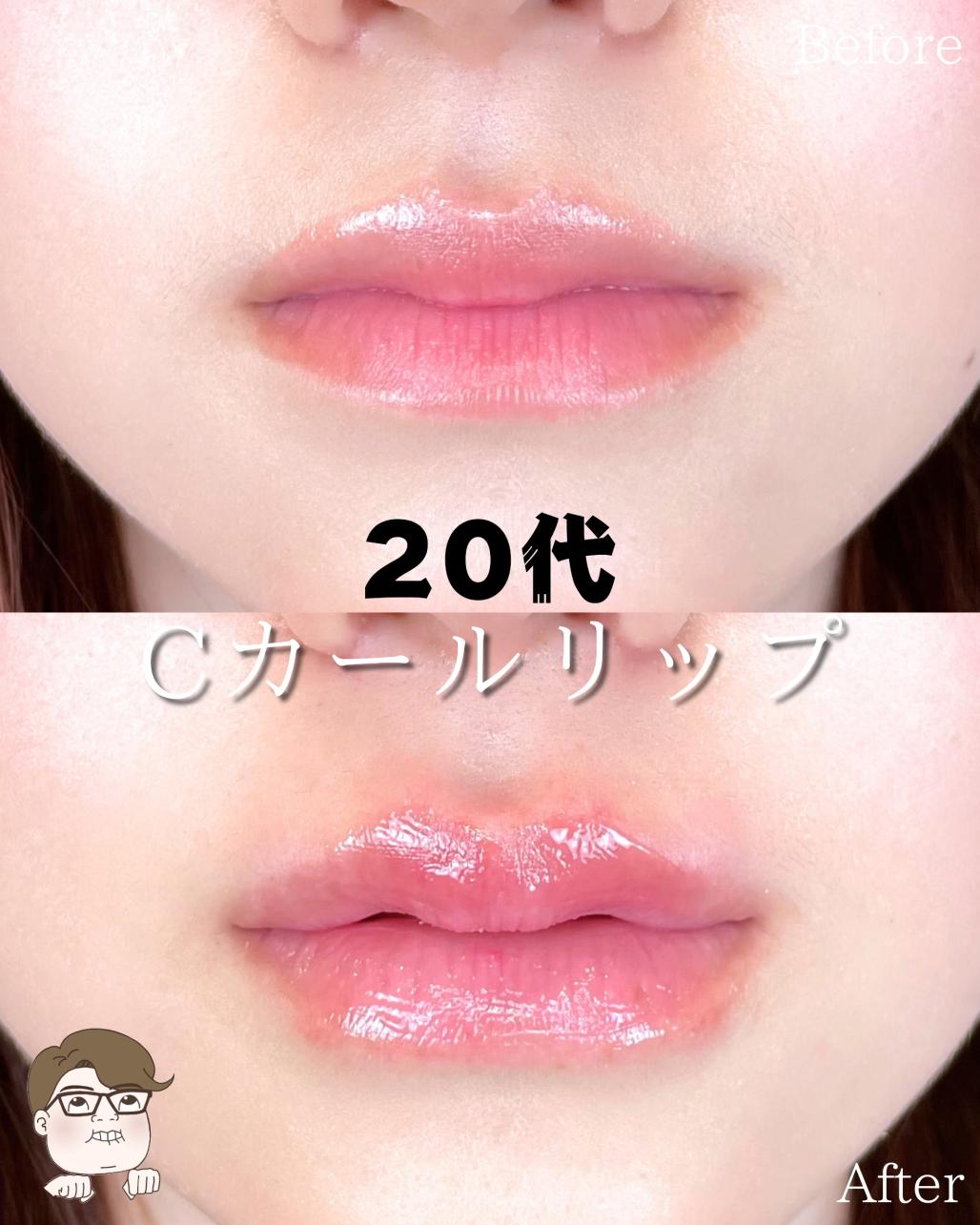 Ｃカールリップの症例写真