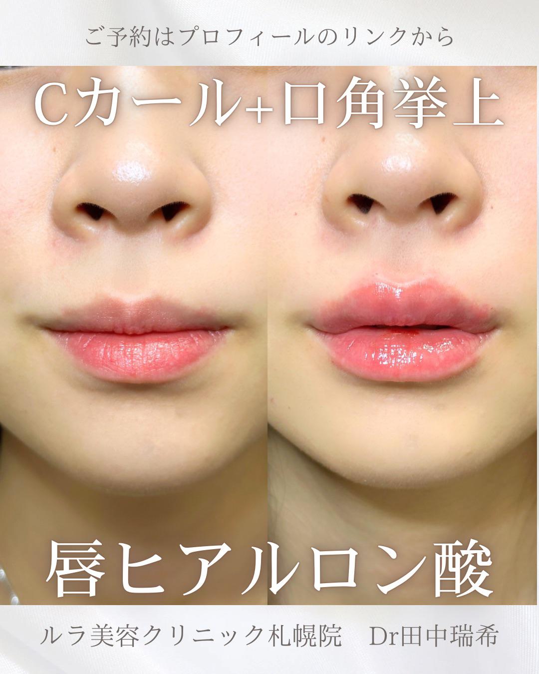 Ｃカールリップの症例写真