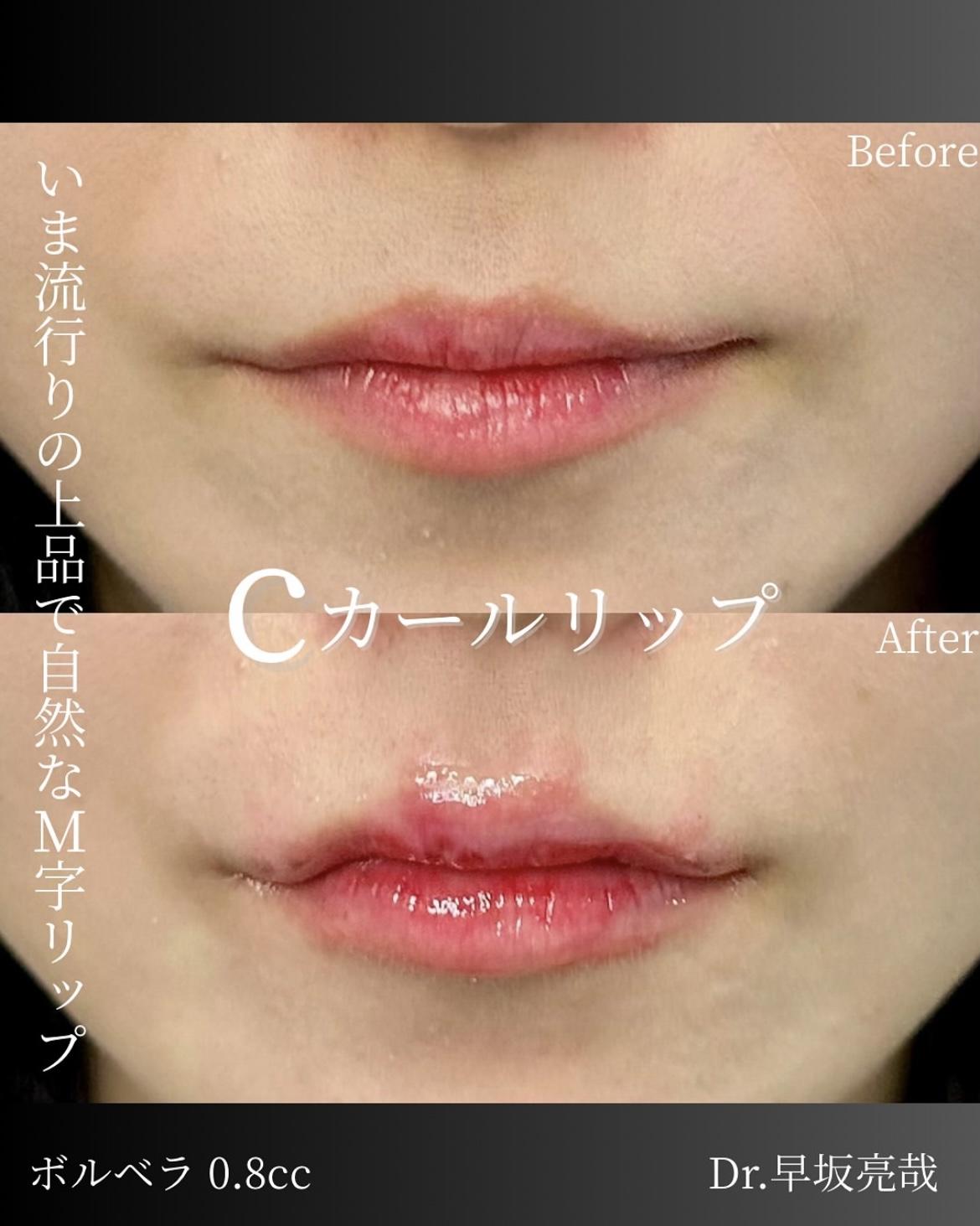 Ｃカールリップの症例写真