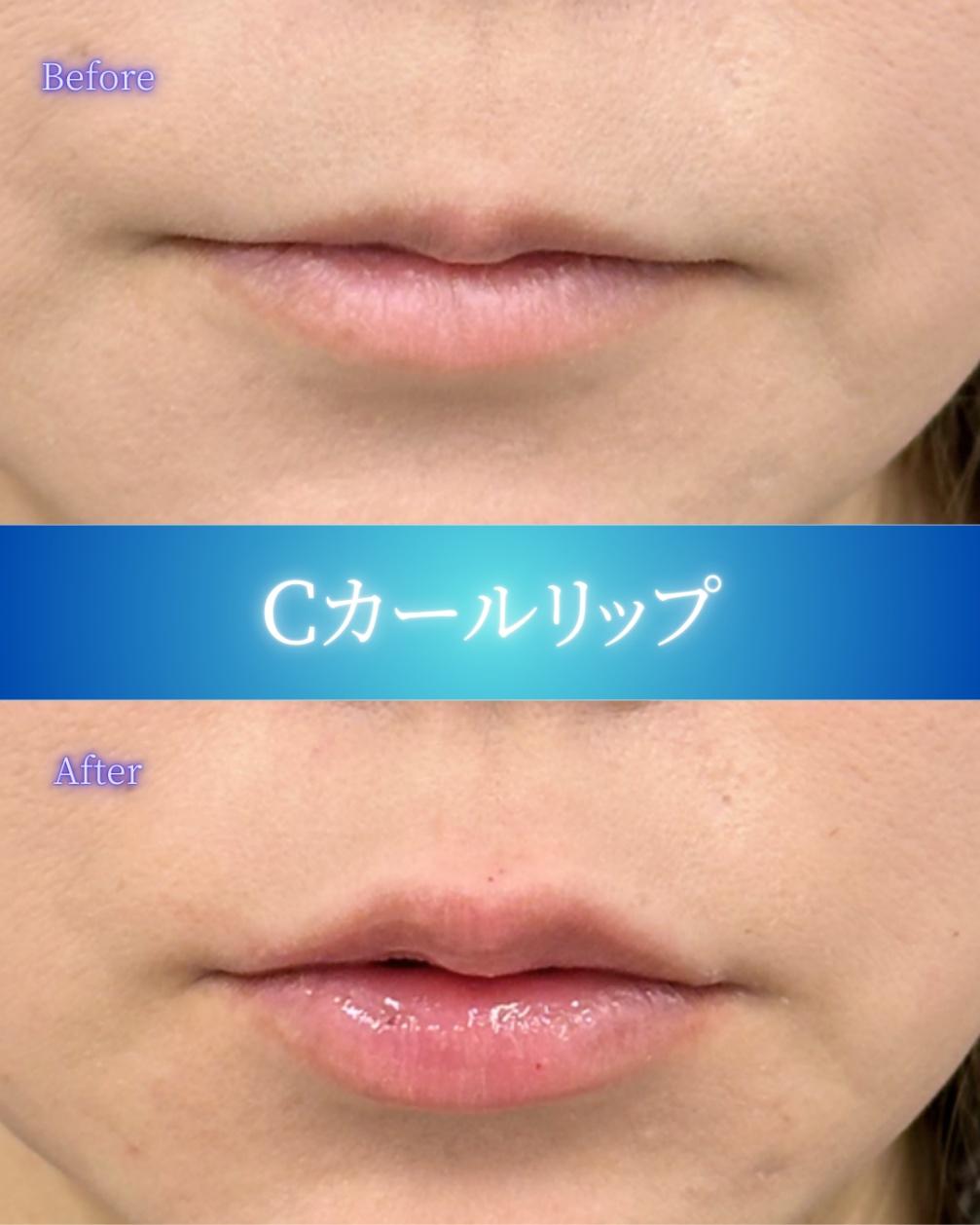 Ｃカールリップの症例写真