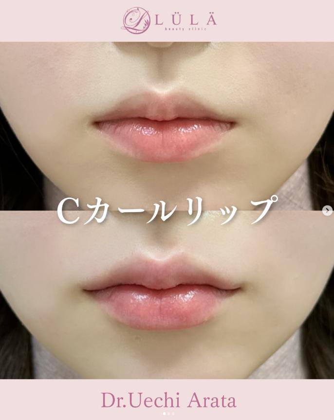 Ｃカールリップの症例写真