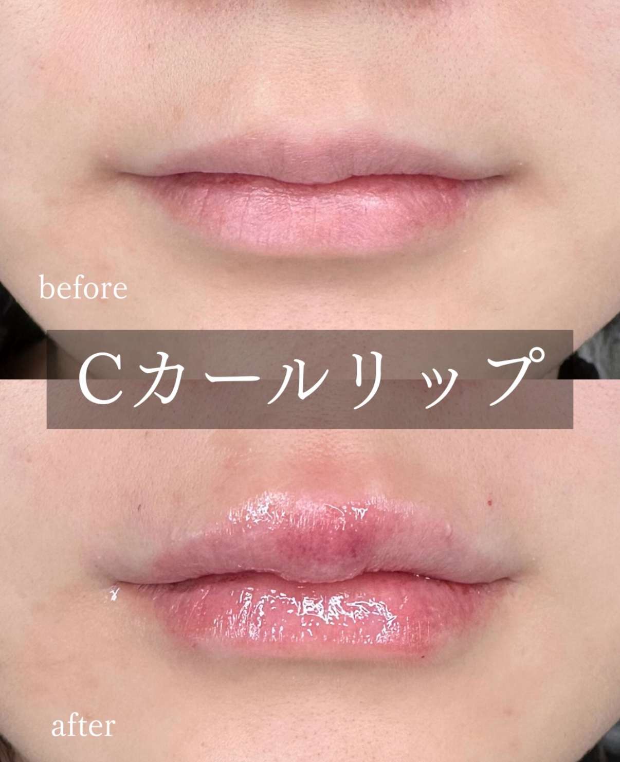 Ｃカールリップの症例写真