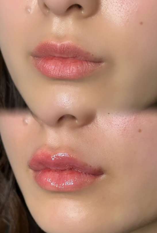 Ｃカールリップの症例写真