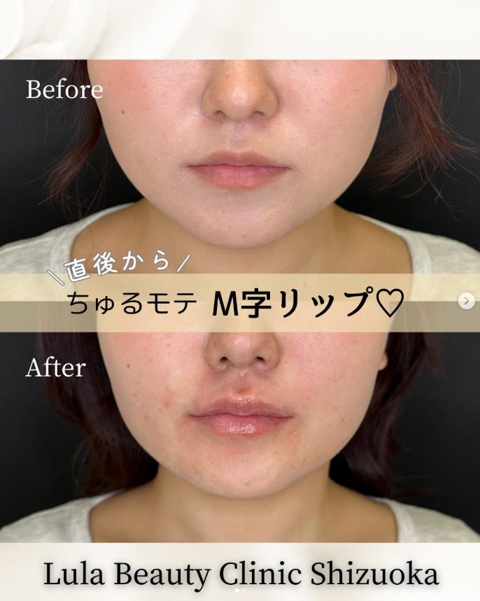 Ｃカールリップの症例写真