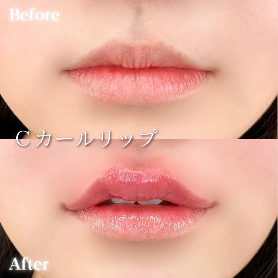 Ｃカールリップの症例写真