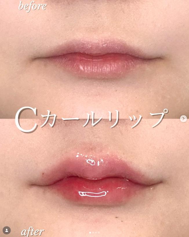 Ｃカールリップの症例写真