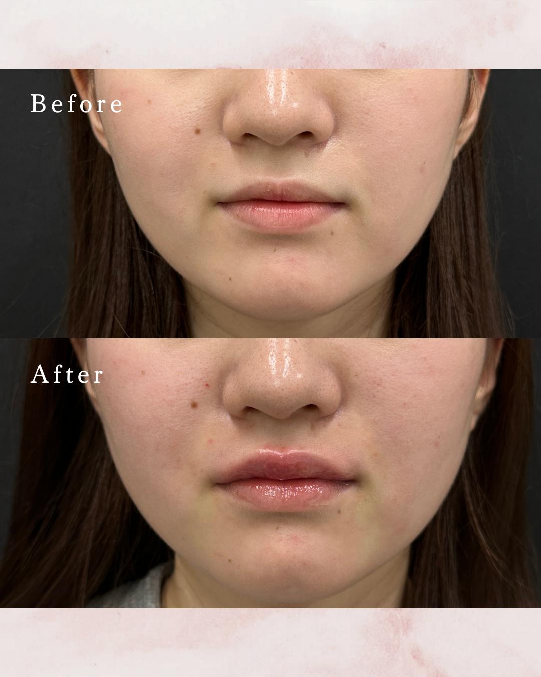 Ｃカールリップの症例写真