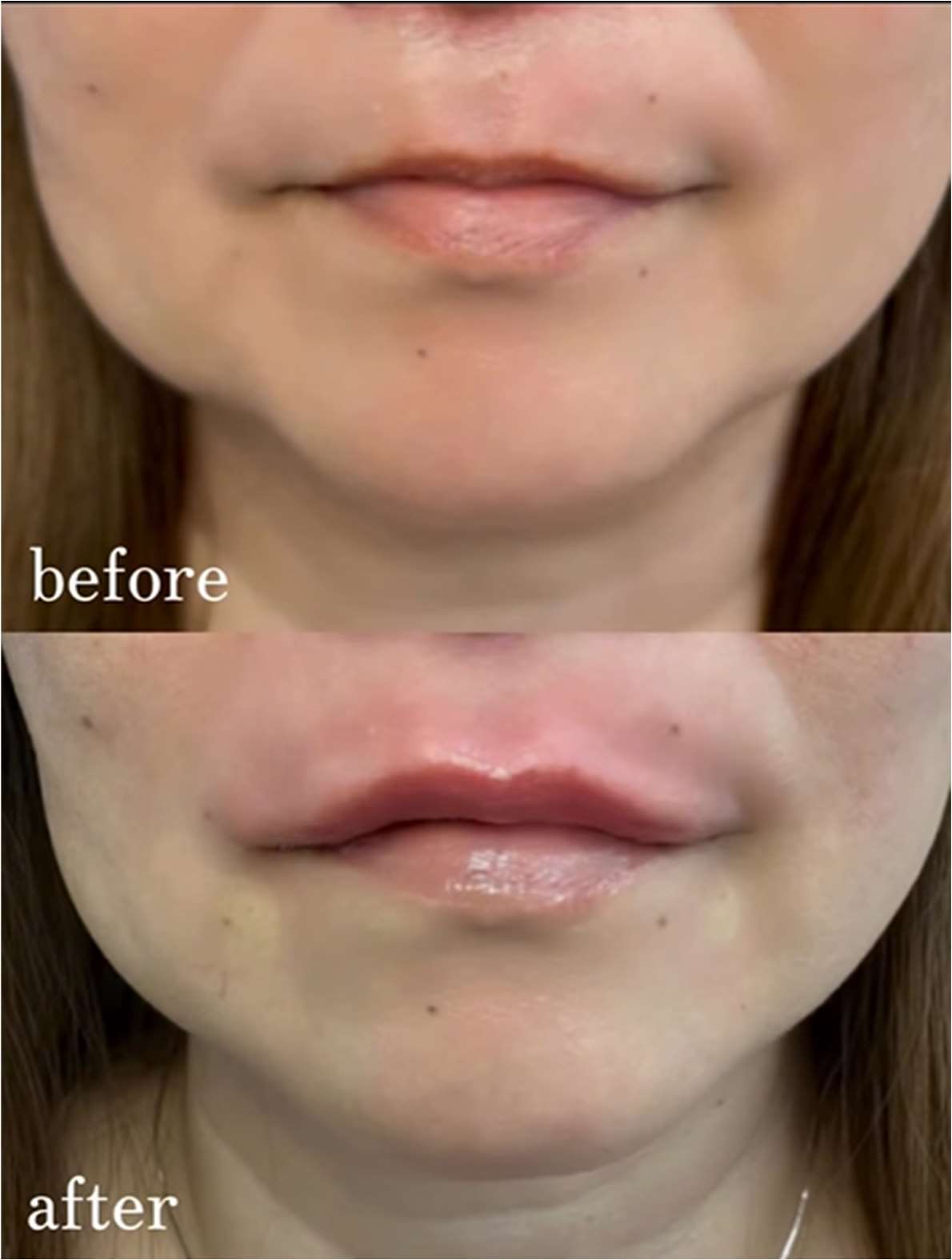 Ｃカールリップの症例写真