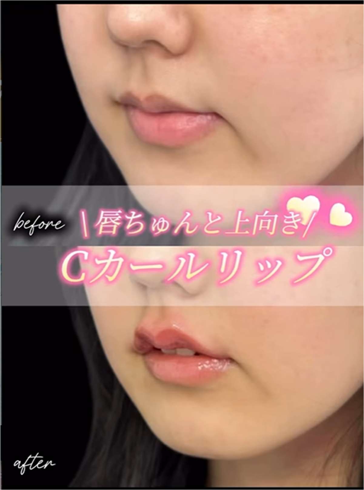 Ｃカールリップの症例写真