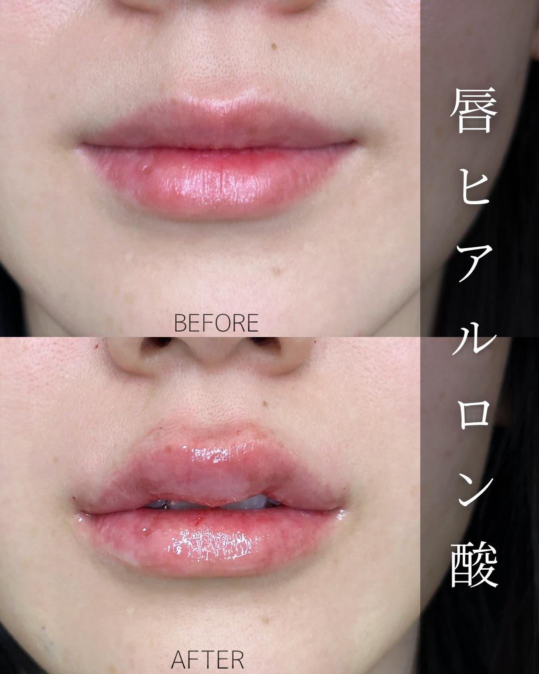 Ｃカールリップの症例写真