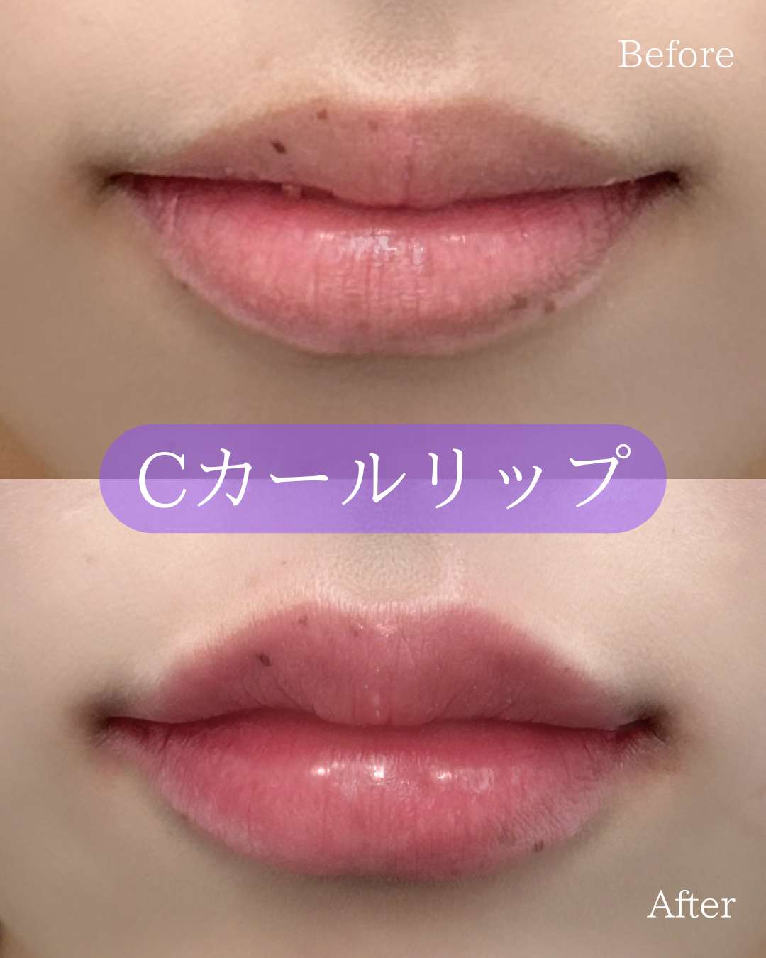 Ｃカールリップの症例写真