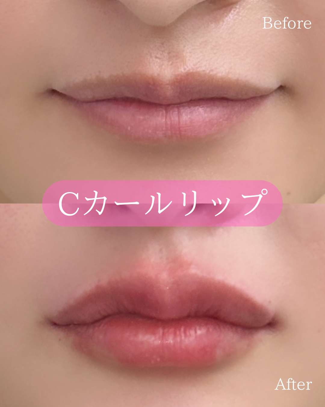 Ｃカールリップの症例写真