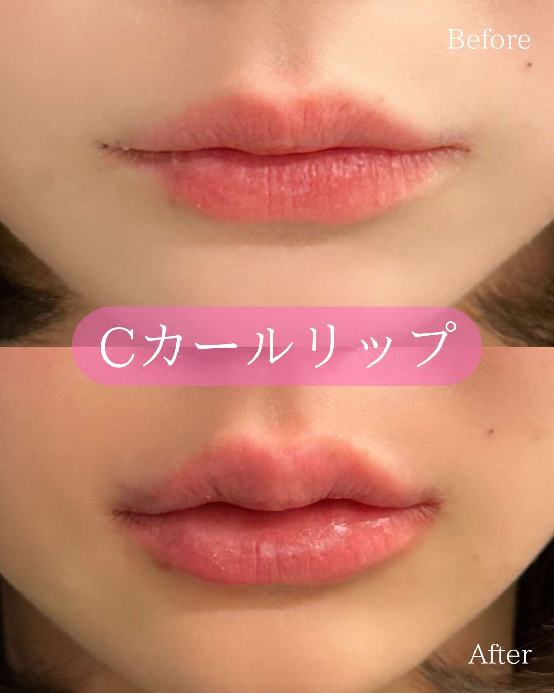 Ｃカールリップの症例写真