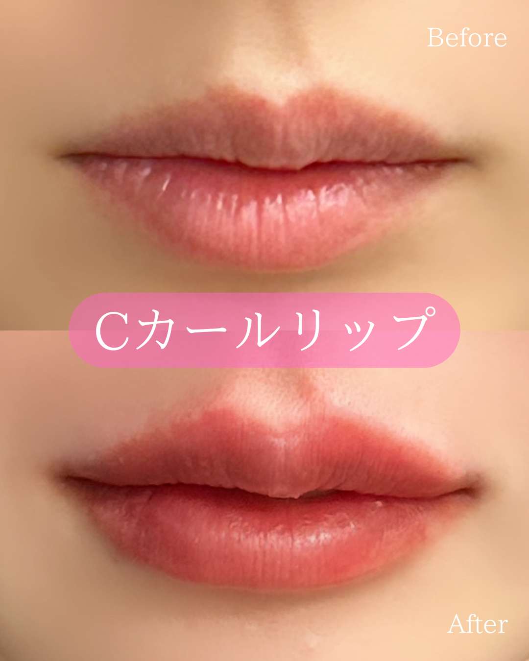 Ｃカールリップの症例写真