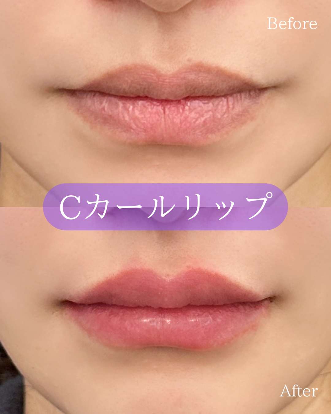 Ｃカールリップの症例写真