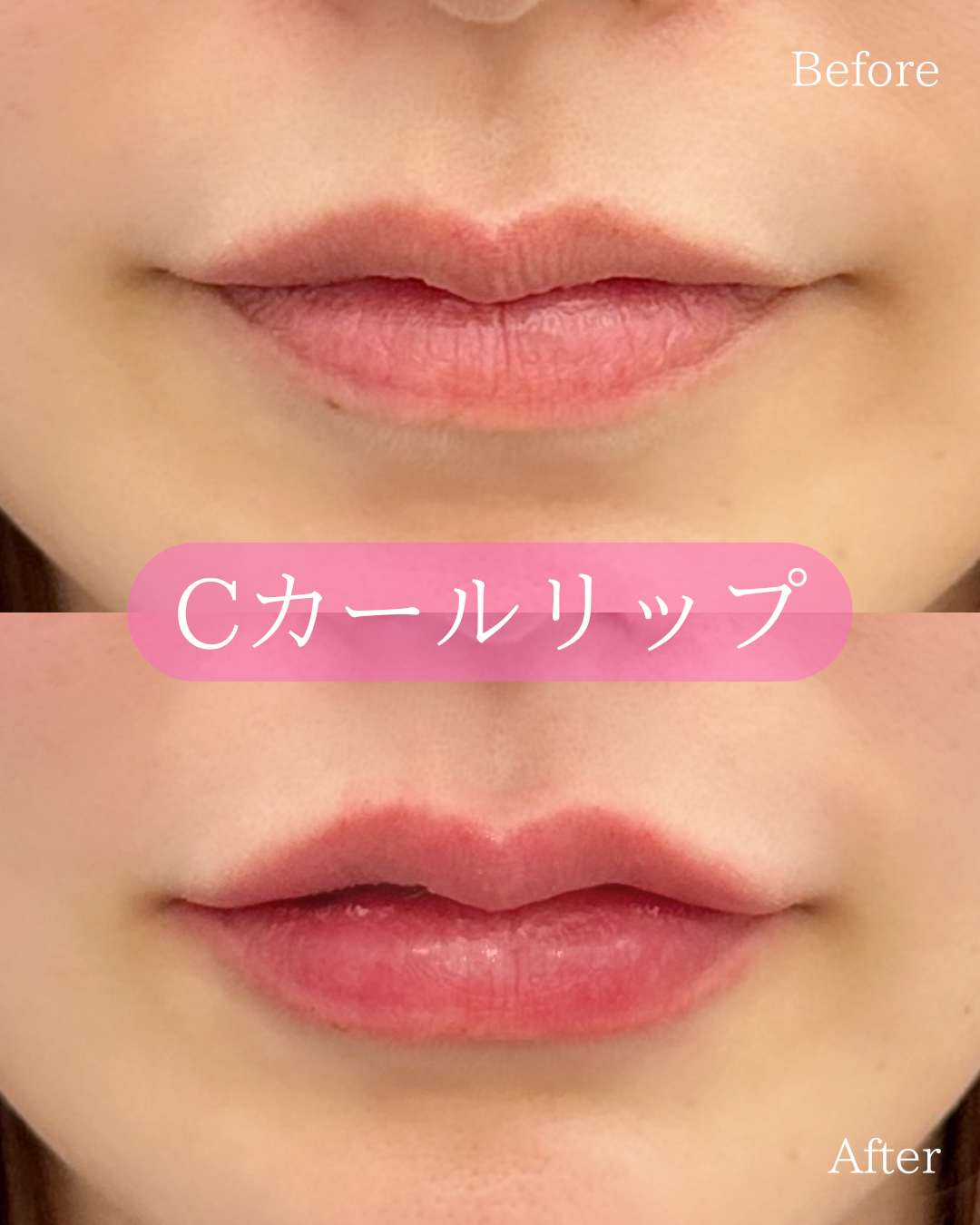 Ｃカールリップの症例写真