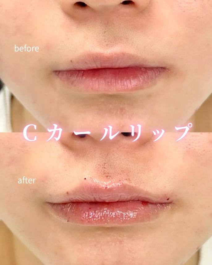 Ｃカールリップの症例写真