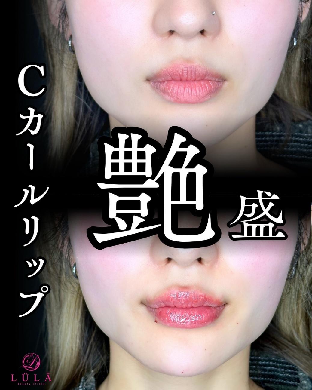 Ｃカールリップの症例写真