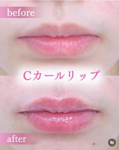 Ｃカールリップの症例写真