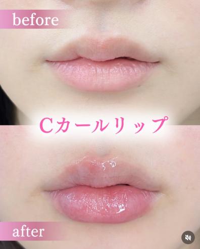 Ｃカールリップの症例写真