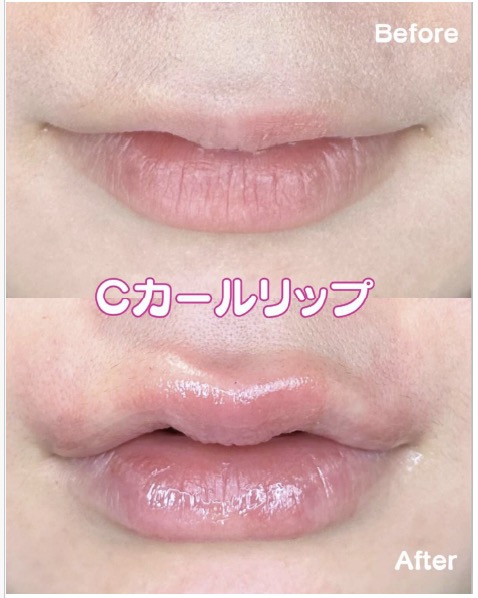 Ｃカールリップの症例写真