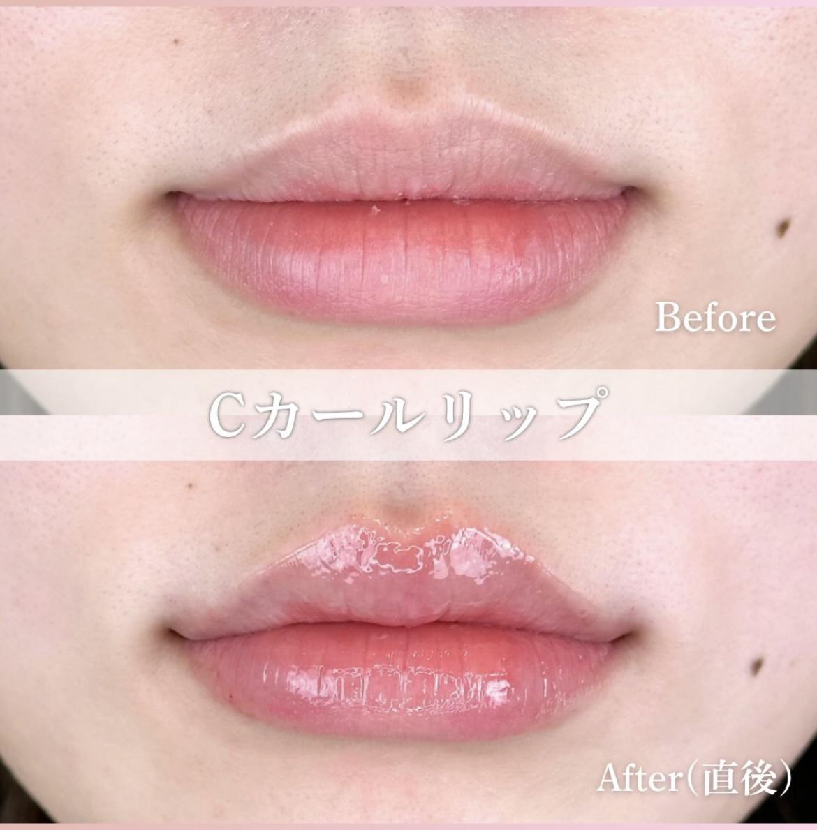 Ｃカールリップの症例写真