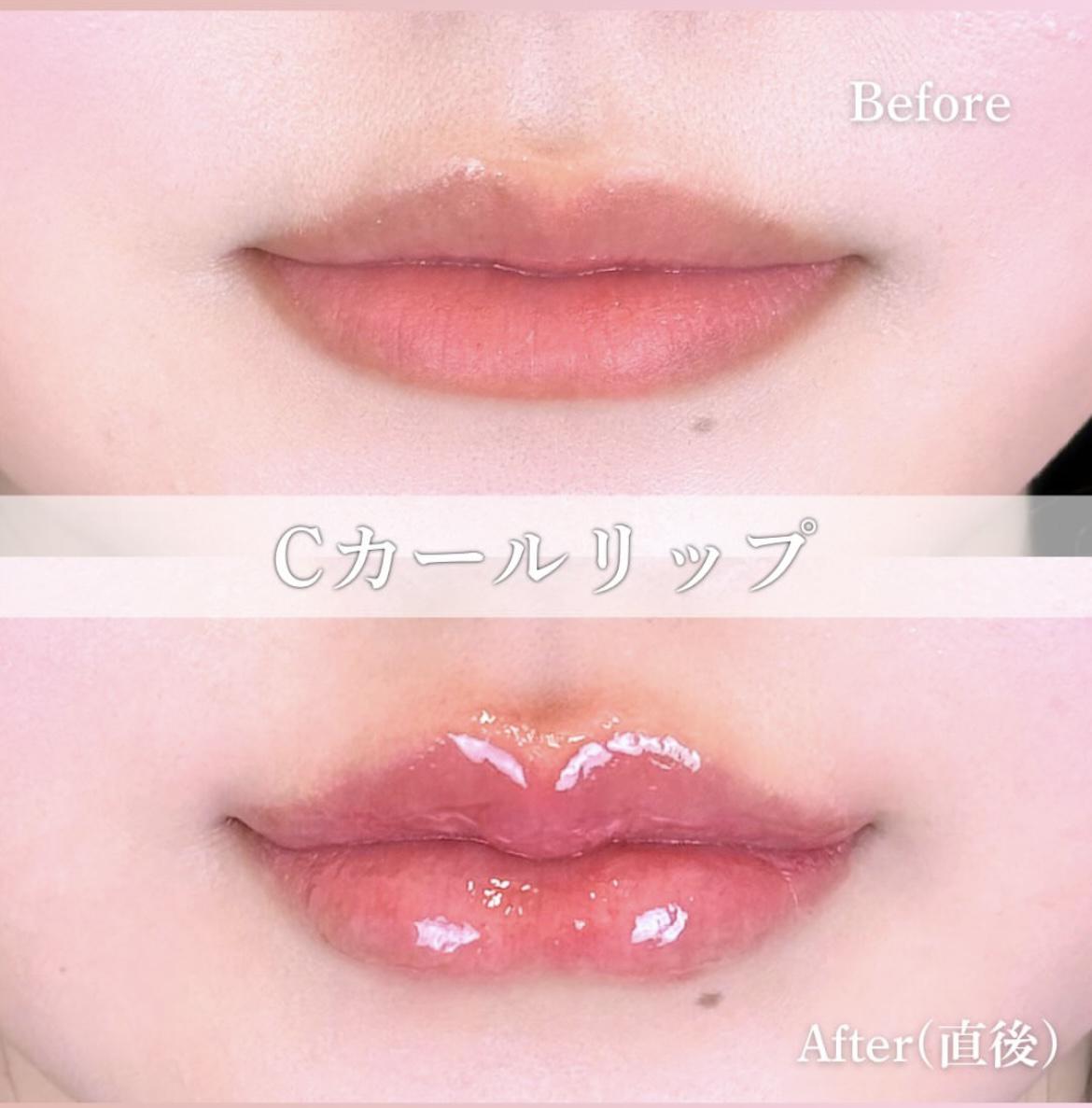 Ｃカールリップの症例写真