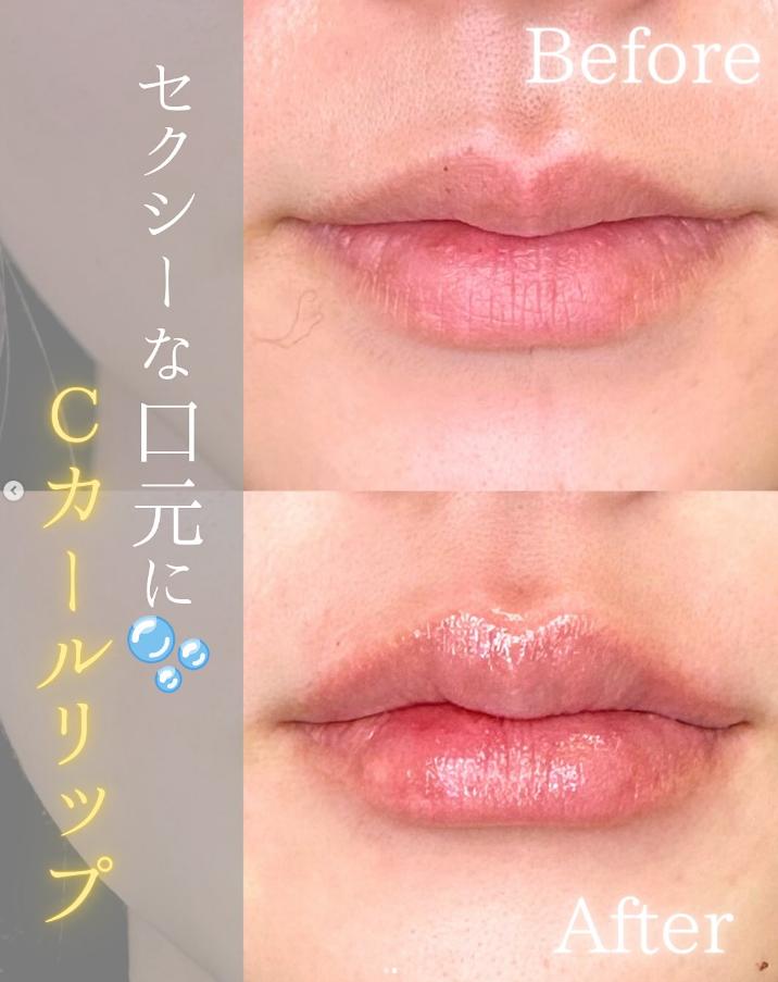 Ｃカールリップの症例写真